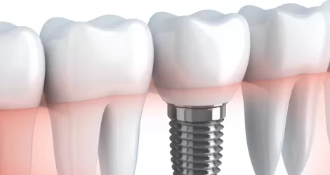 Implantati & All On Four / Six