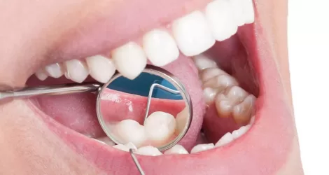 Composite fillings