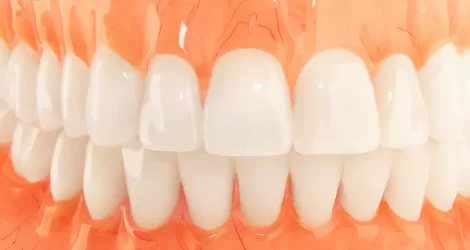 Full and Partial Dentures